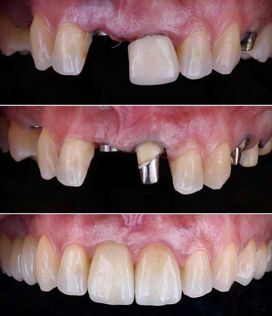 حالات زراعة الاسنان قبل و بعد