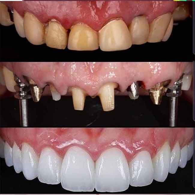 حالات زراعة الاسنان قبل و بعد 2