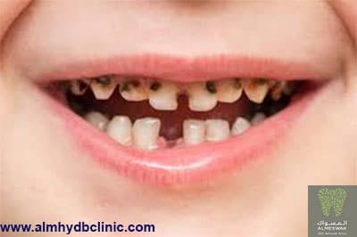اسباب تسوس اسنان الاطفال وطرق الوقاية والعلاج في المنزل