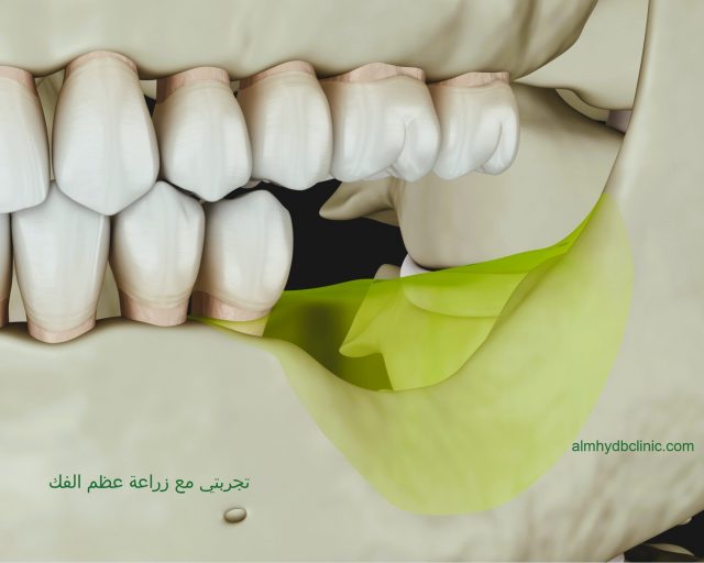 تجربتي مع زراعة عظم الفك و هل تؤثر زراعة الأسنان على الجيوب الأنفية
