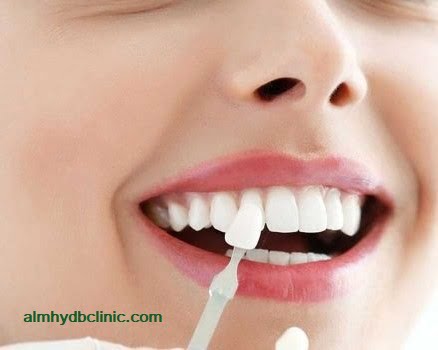 تلبيس الاسنان الزيركون تعرف على الاسعار، الانواع، والاضرار