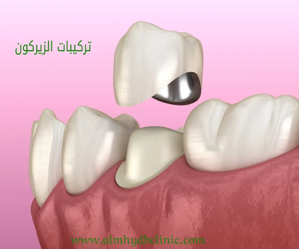 9 انواع تركيبات الاسنان تعرف علي افضل نوع، عروض تركيبات الاسنان في المهيدب