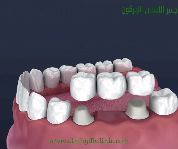 9 انواع تركيبات الاسنان تعرف علي افضل نوع، عروض تركيبات الاسنان في المهيدب
