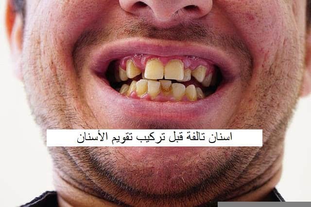 اسنان شخص قبل تركيب تقويم الاسنان