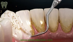 طريقة تنظيف الاسنان من الجير هل تنظيف الاسنان يؤثر علي طبقة المينا للاسنان؟