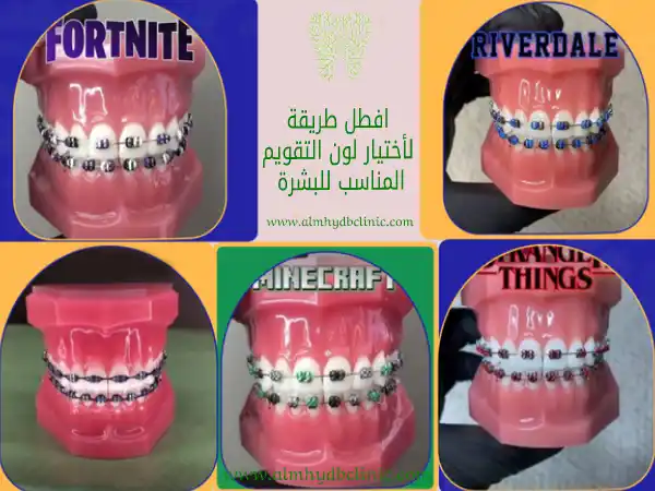 الوان التقويم الاسنان