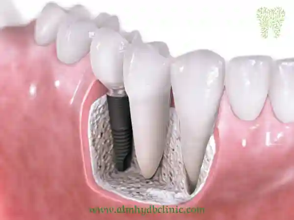 سعر زراعة الأسنان الفورية | افضل دكتور زراعة اسنان في المهيدب الرياض