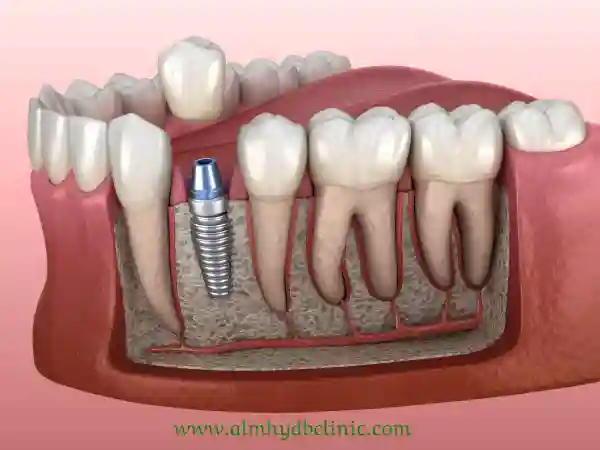 طريقة زراعة الاسنان بالتفصيل ومتى تنفك خيوط زراعة الأسنان