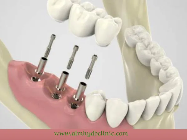 ماهي طرق زراعة الاسنان بدون جراحة؟