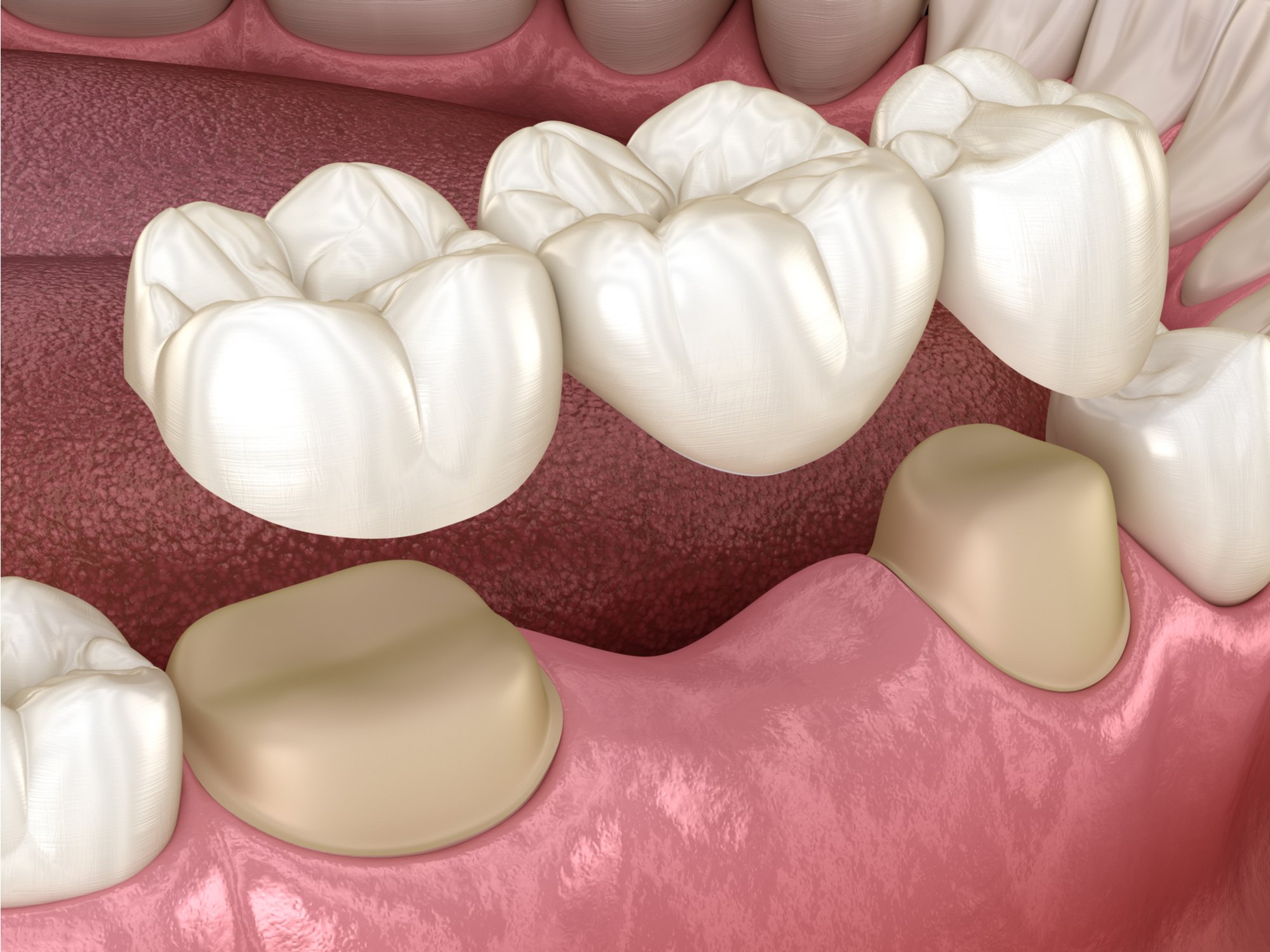 أنواع تلبيس الاسنان