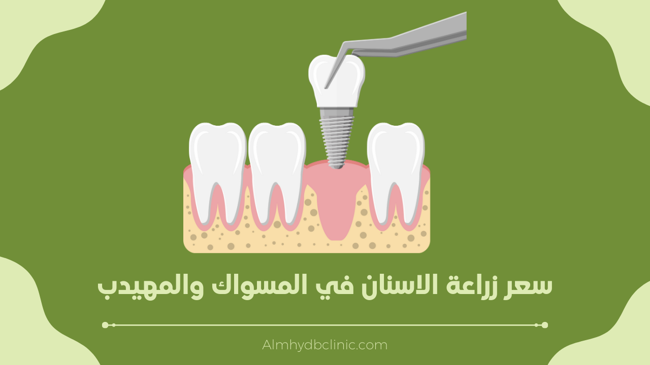 اسعار زراعة الاسنان في السعودية (المسواك والمهيدب)