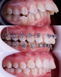 تقويم الاسنان قبل وبعد