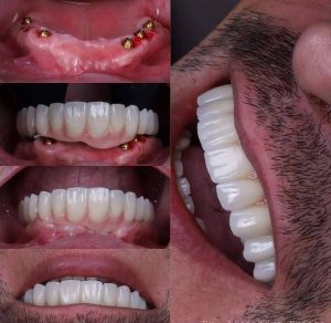 زراعة الاسنان قبل وبعد بالصور