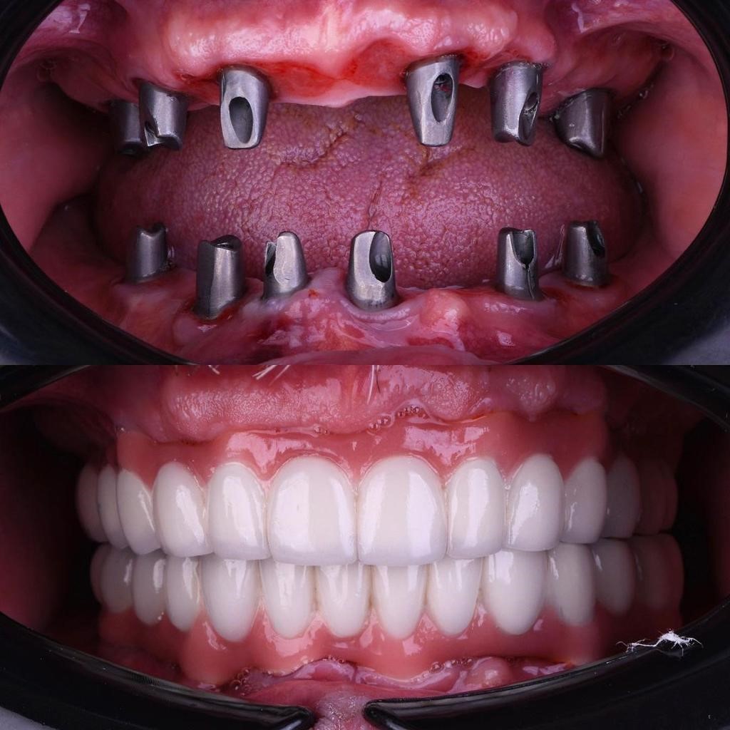 زراعة الاسنان قبل وبعد بالصور 5