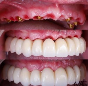 زراعة الاسنان قبل وبعد بالصور