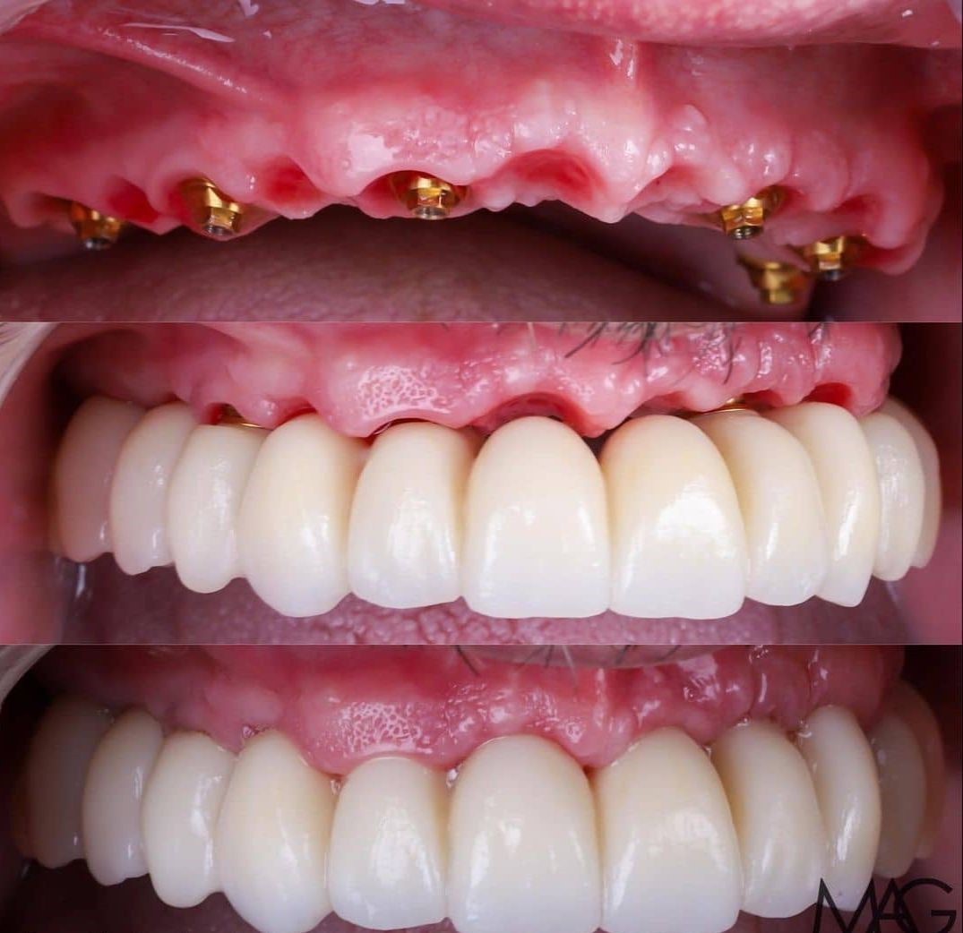 زراعة الاسنان قبل وبعد بالصور 6