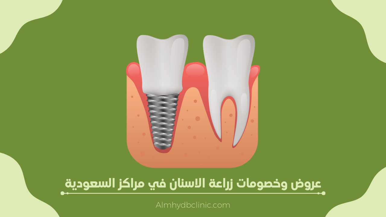 عروض زراعة الاسنان في مراكز وعيادات الاسنان في السعودية