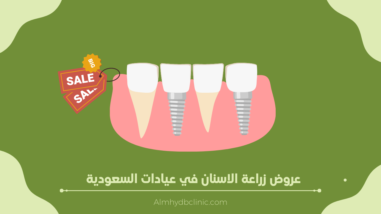 عروض زراعة الاسنان في المسواك، المهيدب وفي السعودية