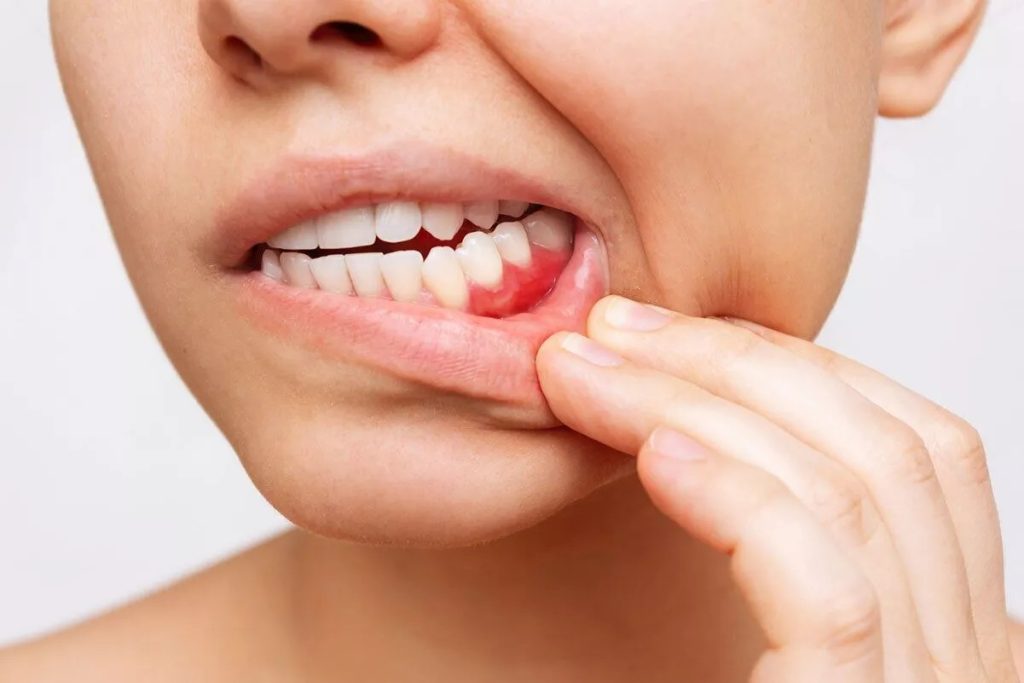 نصائح لتجنب التهاب اللثة والأسنان