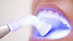 أحدث أنواع تنظيف الأسنان في العيادات
