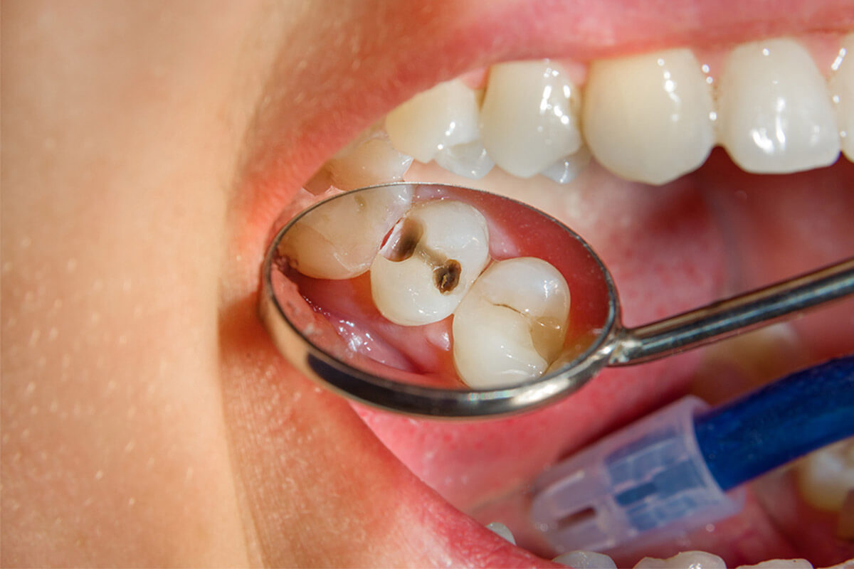 أسباب حدوث  ثقب الأسنان 