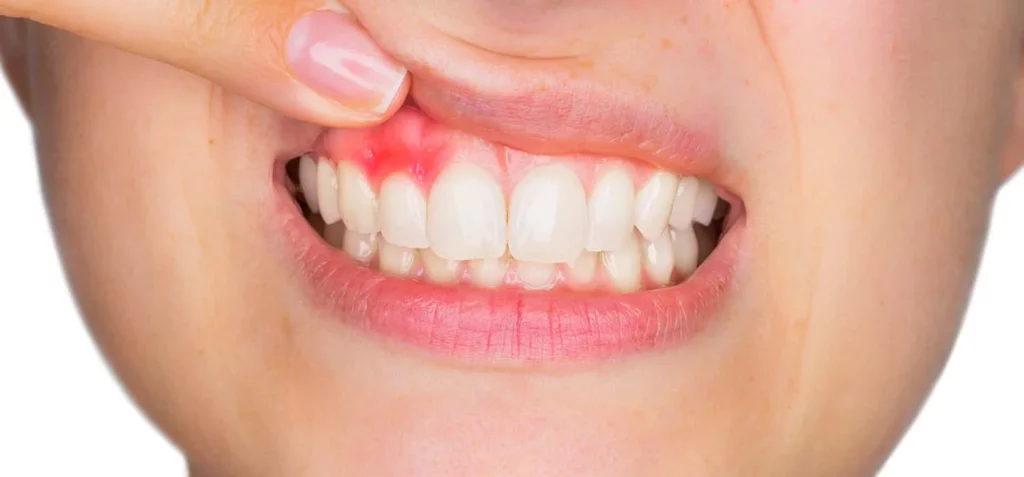 اسباب حدوث  التهاب اللثة بعد زراعة الأسنان