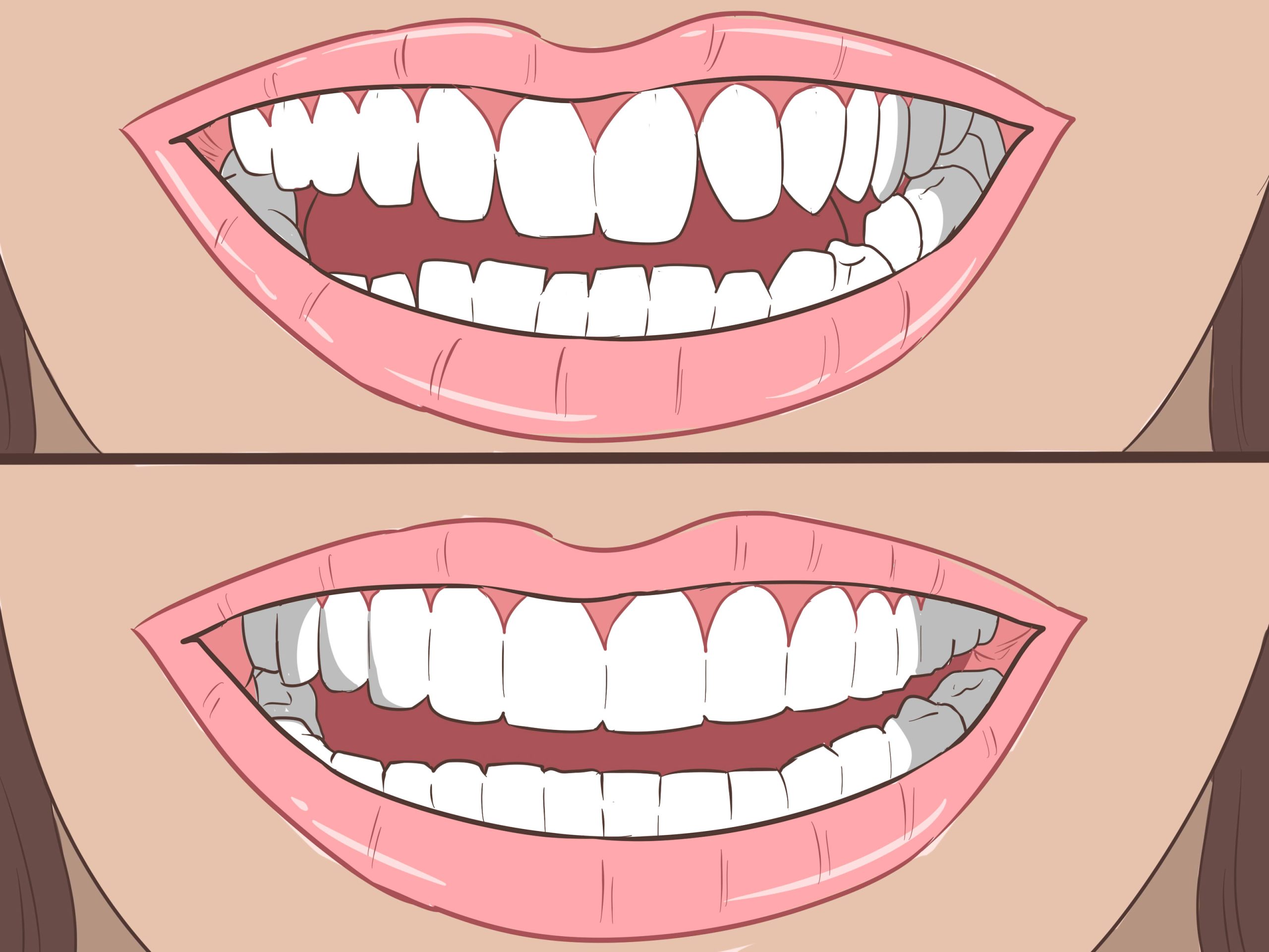 اسباب علاج فراغات الأسنان بدون تقويم