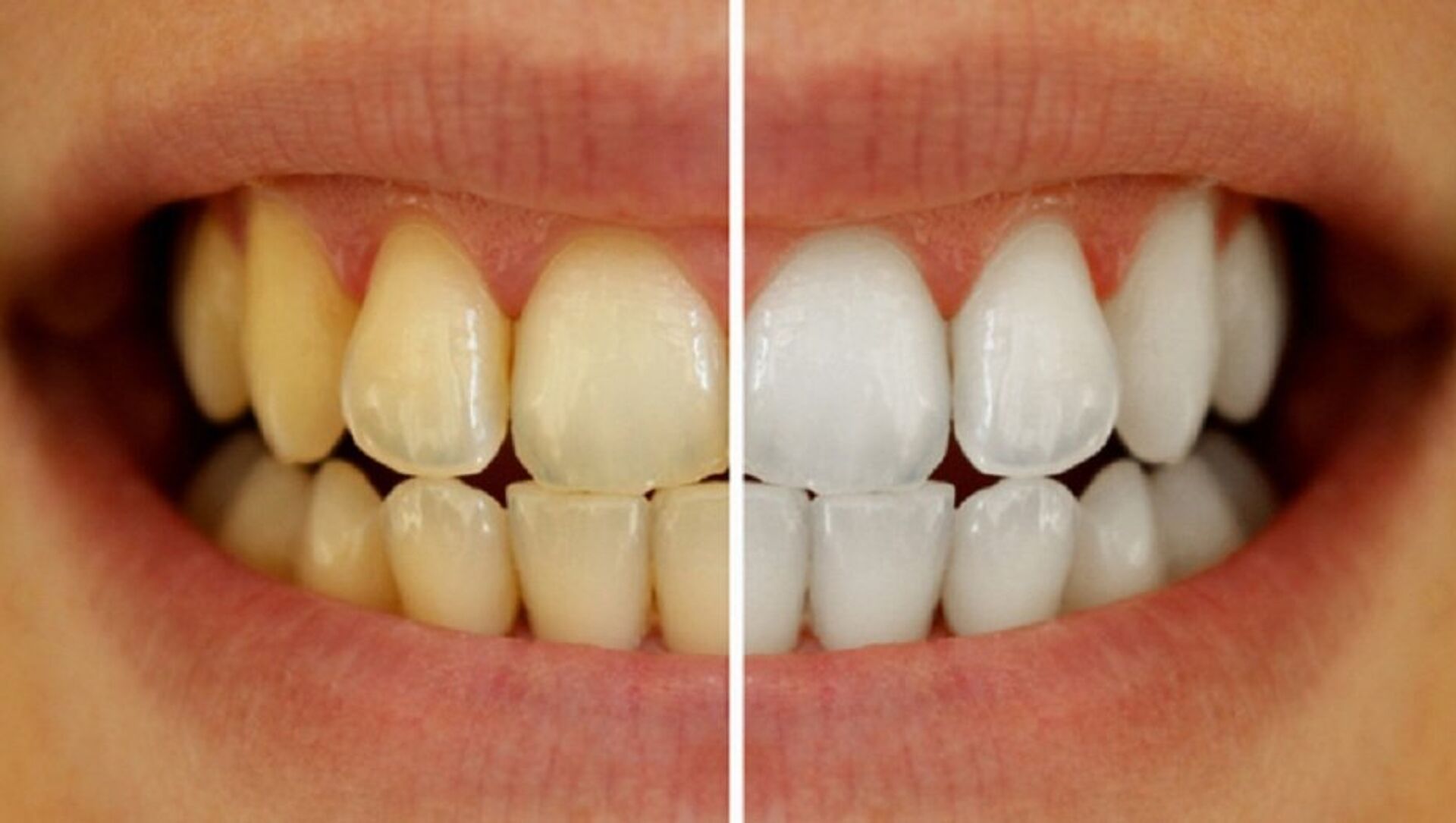 التأثير السلبي لاصفرار الاسنان 