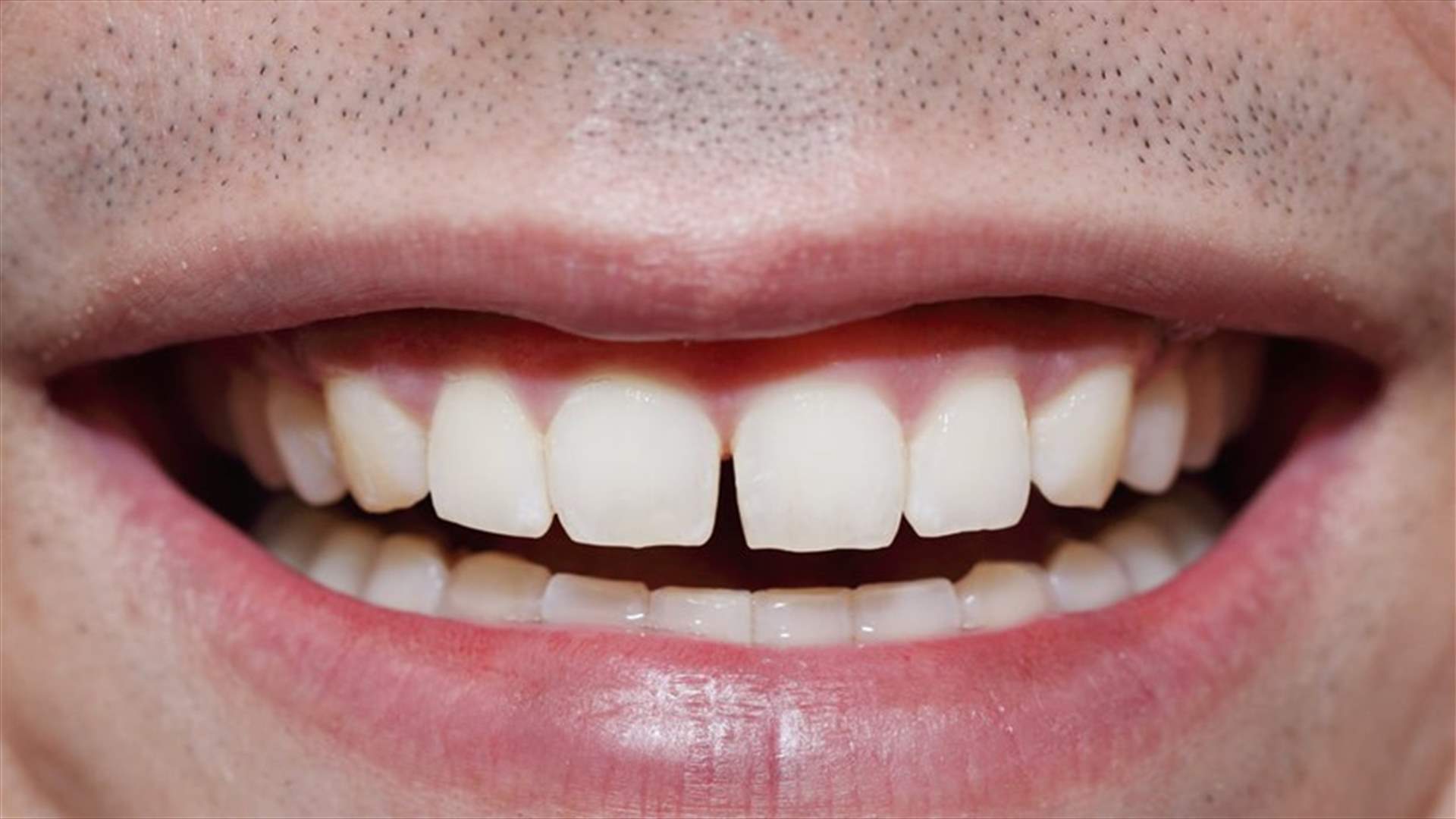 تطبيقات تجميلية للأسنان (Veneers)