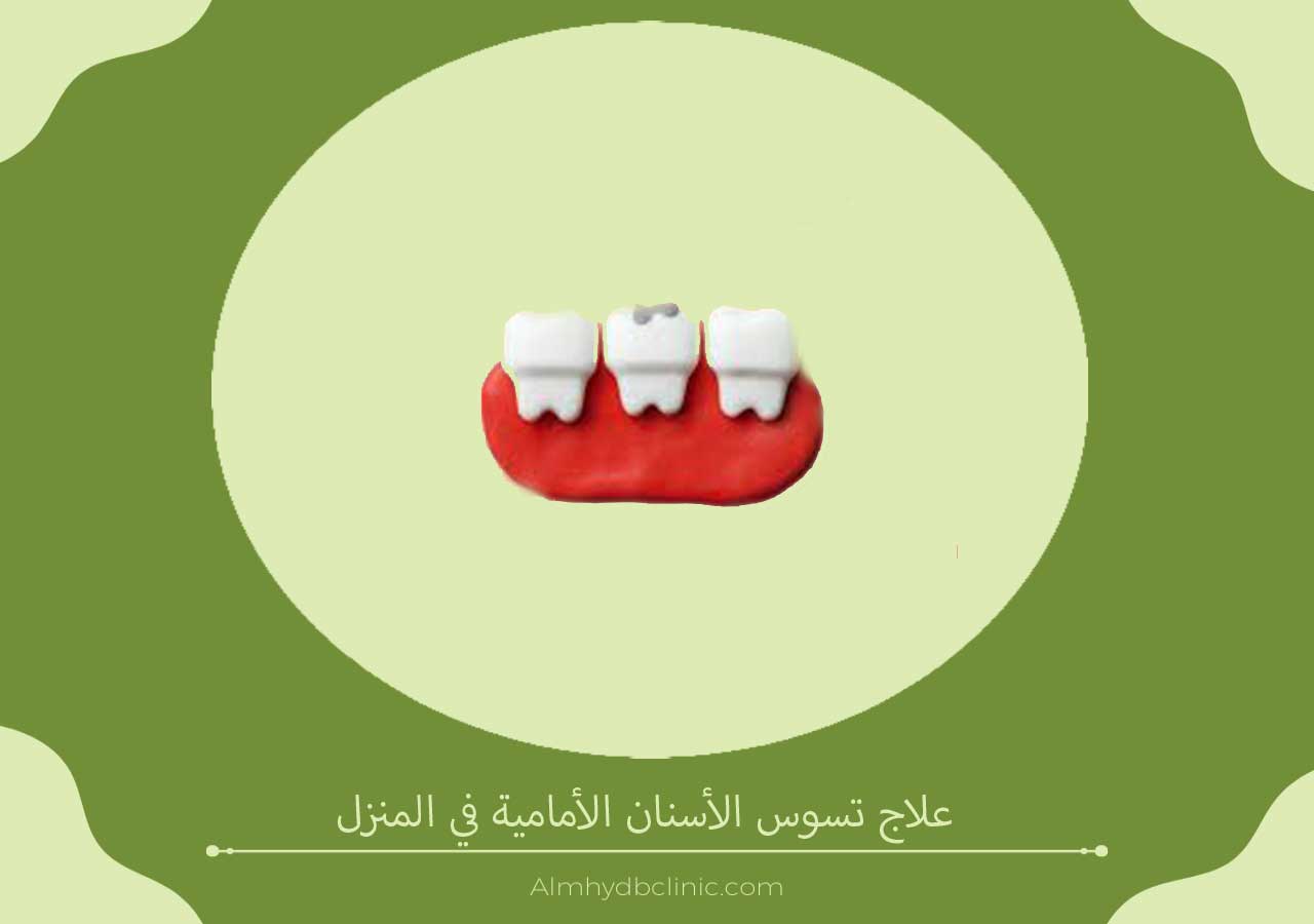 علاج تسوس الأسنان الأمامية في المنزل
