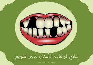 علاج فراغات الأسنان بدون تقويم