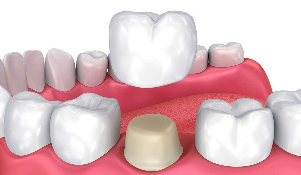 عوامل تحديد أنواع طربوش الأسنان واسعارها 