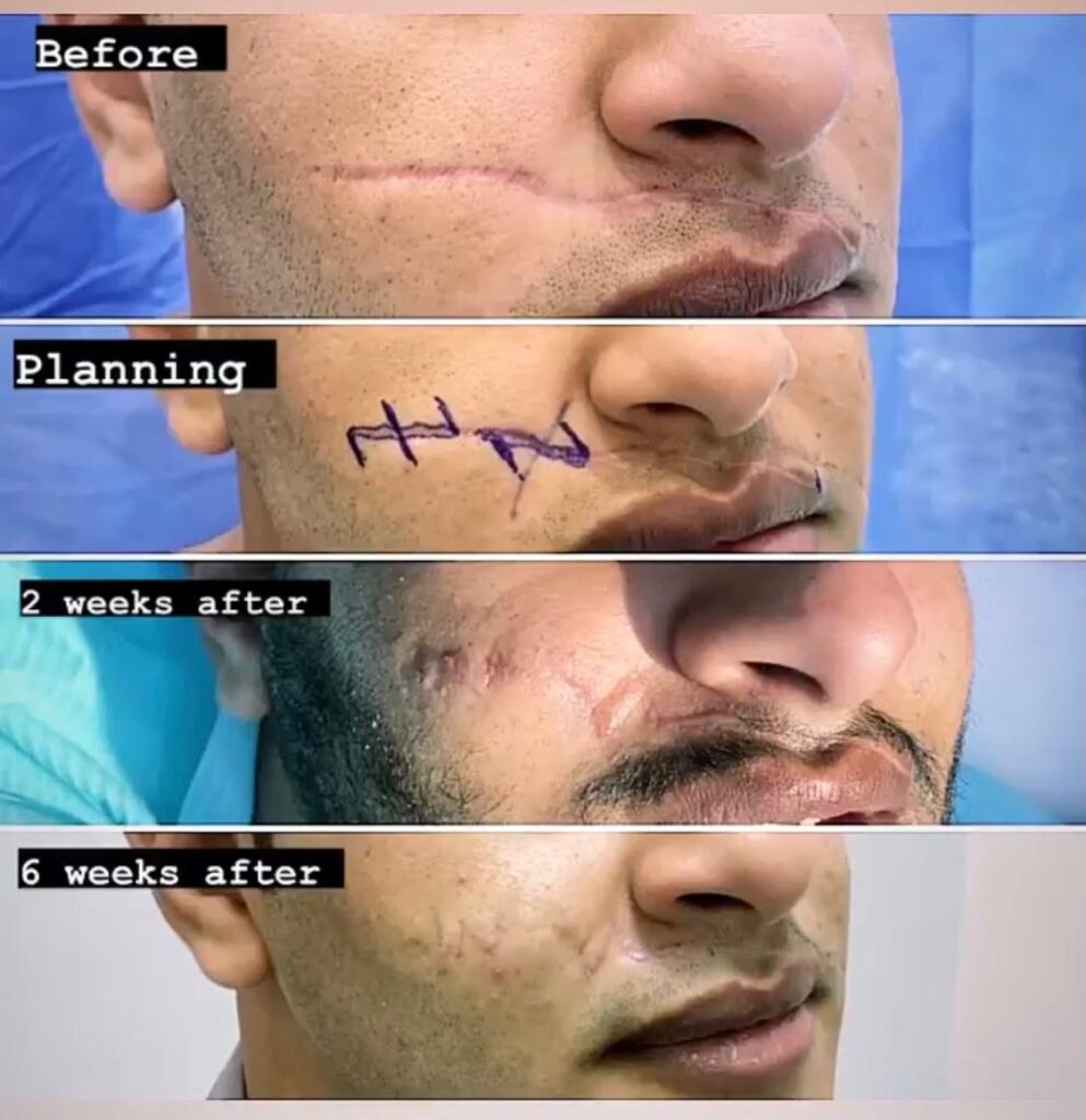 كيف يؤثر موقع الجرح على سعر عملية التجميل