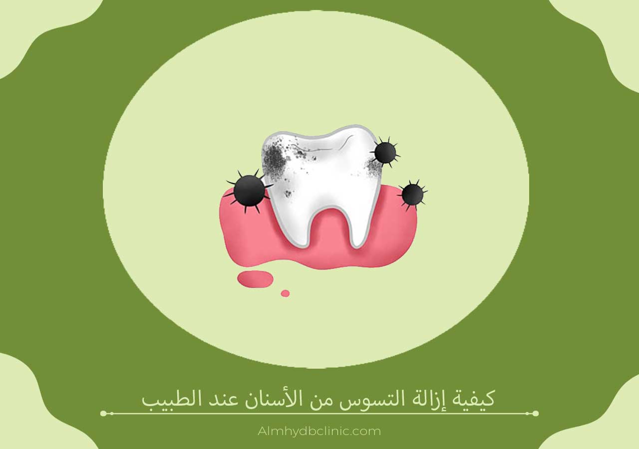 كيفية إزالة التسوس من الأسنان عند الطبيب