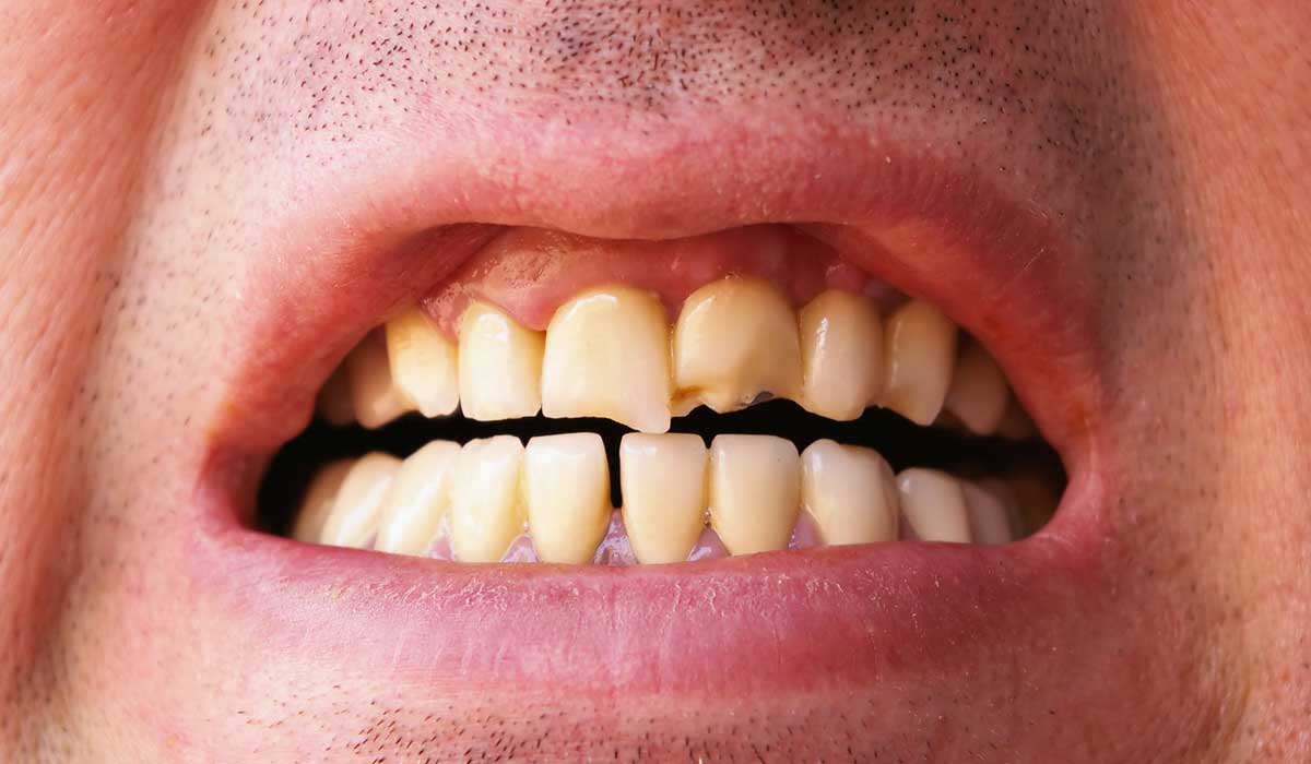 كيفيه الوقاية من تكسر الاسنان