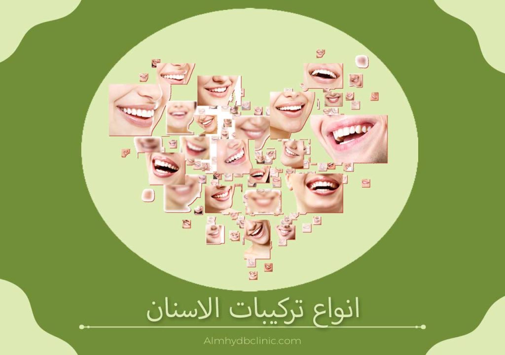 انواع تركيبات الاسنان