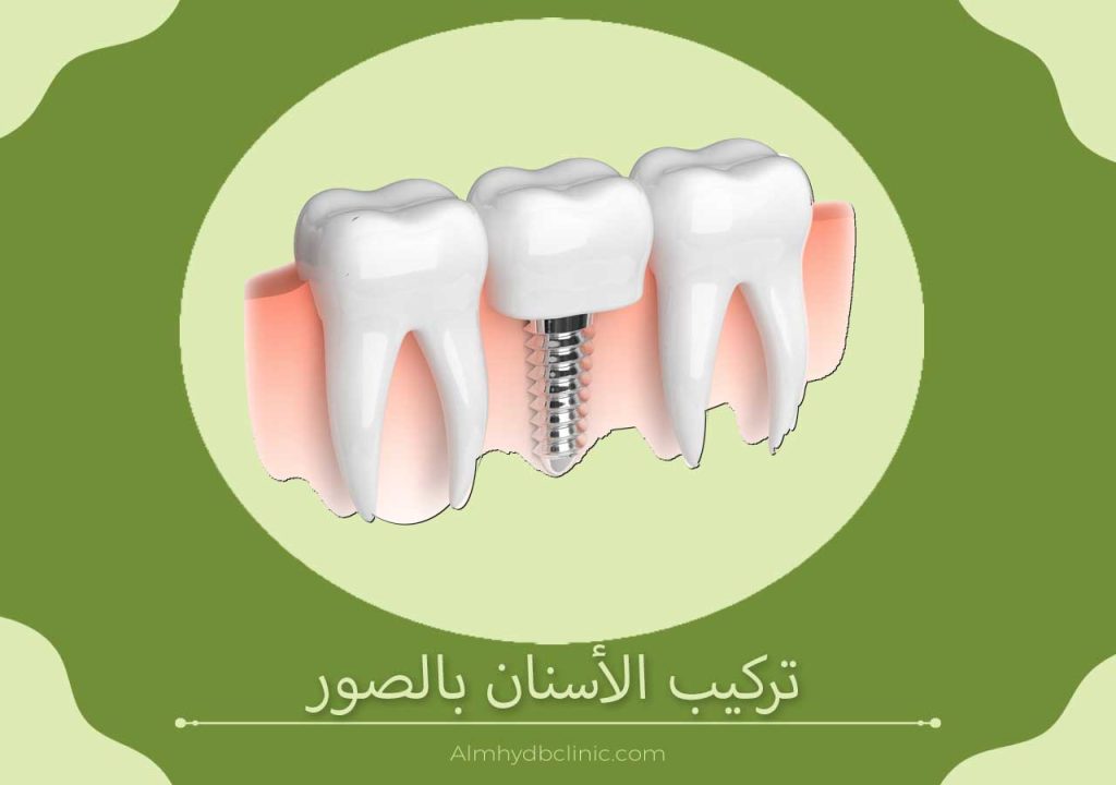 تركيب الأسنان بالصور1