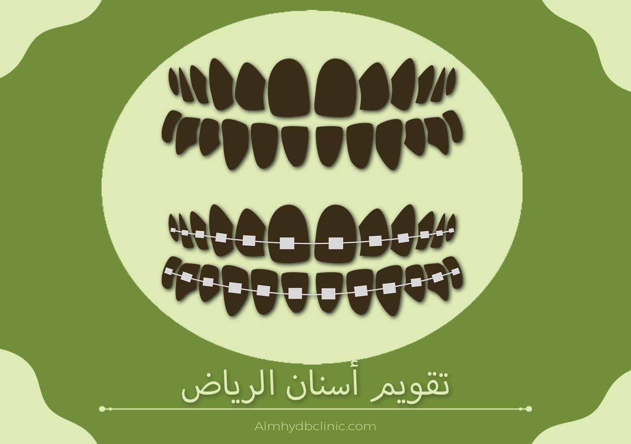 تقويم اسنان الرياض