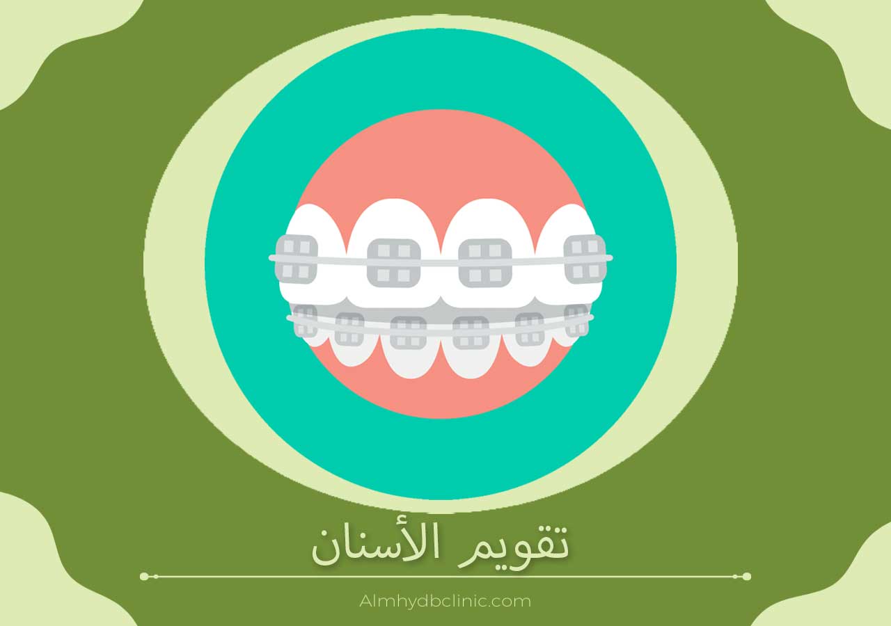تقويم الأسنان المميزات والعيوب والأنواع المختلفة