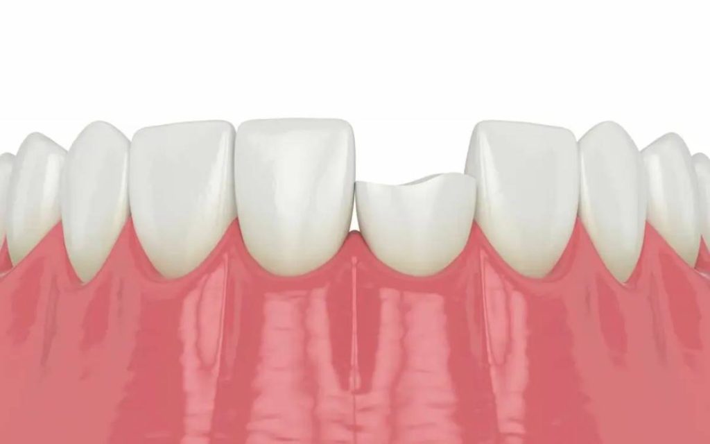 تكسر الأسنان من اشهر أمراض الأسنان واللثة