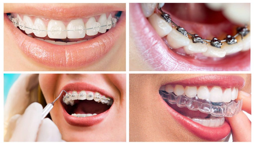 عوامل النجاح في تقويم اسنان الرياض