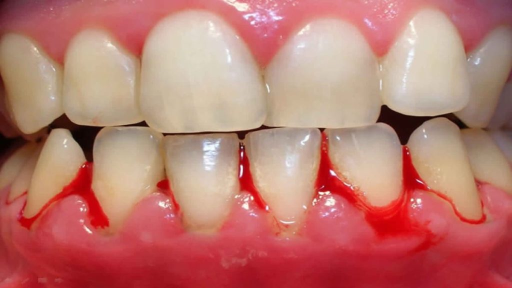 مشاكل اللثة من اشهر أمراض الأسنان واللثة