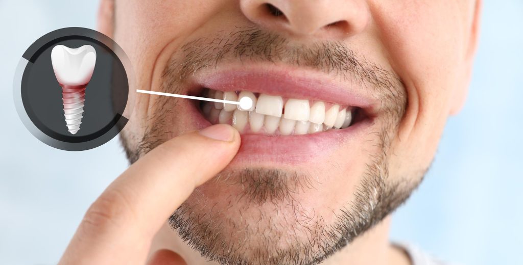 نصائح للحفاظ على صحة الأسنان بعد العلاج