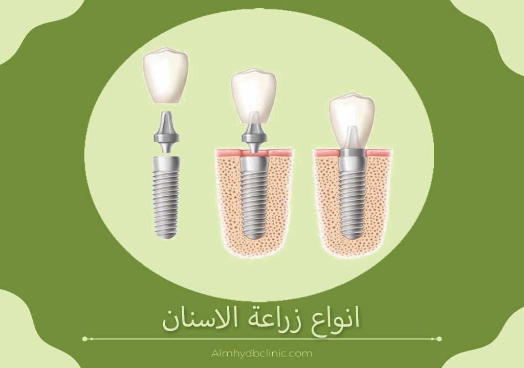 انواع زراعة الاسنان