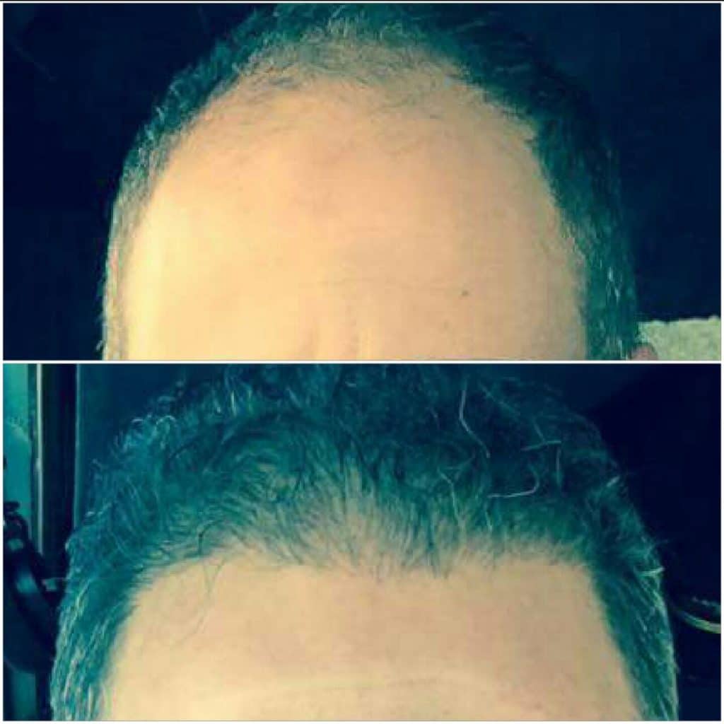 شكل الشعر بعد نتائج زراعة الشعر