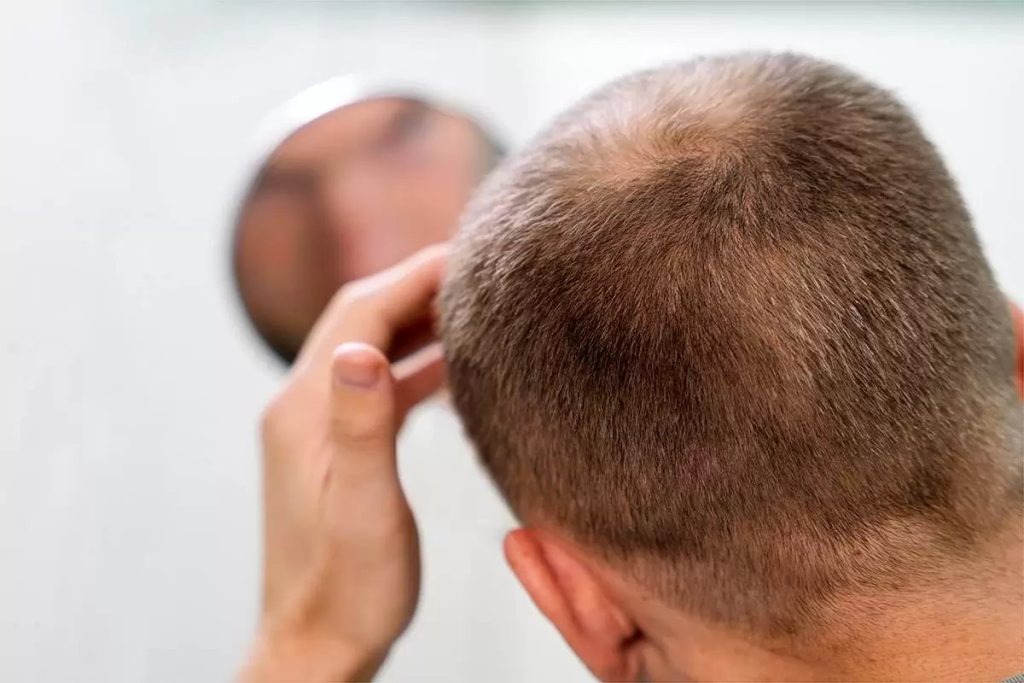 نصائح أخرى بعد عملية زراعة الشعر 